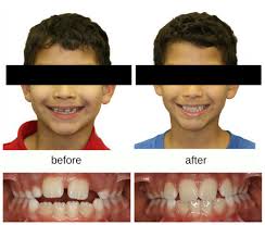 By dr ore december 07, 2015. Orthodontic Habits And Problems In Kids Hometown Orthodontics