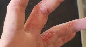 Image result for contact dermatitis