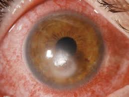 Image result for Keratitis