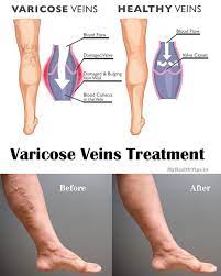 Pin On How To Treat Varicose Veins
