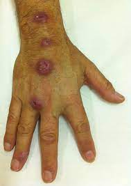 What is sporotrichosis disease or rose gardener's disease ? Rose Thorn Injury Bmj Case Reports