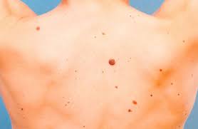 Melanoma is the most serious type of skin cancer, but if you detect it early, treatment your doctor can tell instantly if a spot is cancerous. Skin Cancer How To Recognize And When To See A Doctor