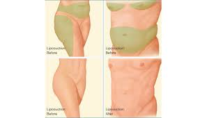 Hughes in los angeles and beverly hills. Body Liposuction Cosmetic Procedure Brigham And Women S Hospital