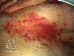 Image result for Intertrigo under breasts