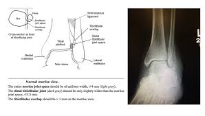 Image result for Ankle XRay