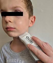 Point of Care Ultrasound (POCUS) Diagnosis of Deep Neck Space Abscess: A  Case Series