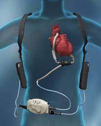 Ventricular Assist Devices Alive With No Pulse Fire Engineering