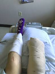 He also branched out into acting. Man In Horrific Car Crash Shares Emotional Moment He Woke Up To Find His Leg Amputated World News Mirror Online