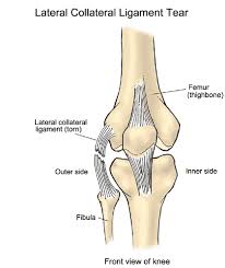 A hamstring tendon strain is a tear or rupture of one of the hamstring tendons at the point where they insert into the back of the knee. Lcl Injury Active Care Physiotherapy Clinic