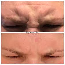 I'm interested in how long your symptoms lasted and if you had any other while botox may not work for everyone it's generally very successful in treating migraines. Botox Before And After My Botox Experience