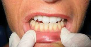 See full list on wikihow.com What Happens To Your Teeth When You Brush With Sea Salt And Baking Soda