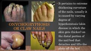 Image result for Onychogryphosis feet