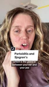 Replying to @Lauren Burns parotiditis is inflammation of the partoid gland.  This is a common manifestation of Sjogren’s disease because it causes  inflammation to this gland. If you struggle with ...