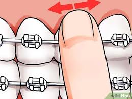 We did not find results for: How To Apply Dental Wax On Braces 12 Steps With Pictures