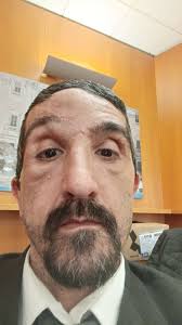 Buongiorno a tutti mi chiamo Francesco sono di Milano e anche io sono  affetto da neurofibromatosi tra schiena e ventre neo tolti almeno 200  ultimamente non ho tolto uno sul sopracciglio sinistro