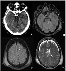 Image result for Diffuse Axonal Injury