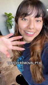 Alyssa Tattoo Removal