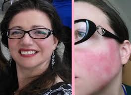 cover a rosacea flare up with makeup