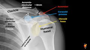 Image result for Shoulder XRay