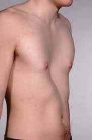 Check spelling or type a new query. Pectus Excavatum Chest Wall Deformities Child Heart Specialist