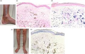Image result for Pigment stains on the shin