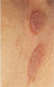 Hautarztpraxis Dr Hempel Pityriasis Rosea
