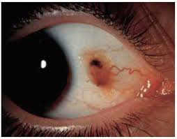 Image result for nevus sclerae