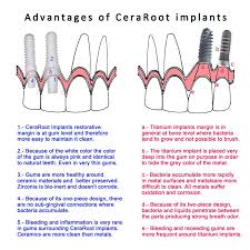 Replacement Black And Decker Workmate Parts Ceraroot Differences Versus Titanium Dental Implants Implants
