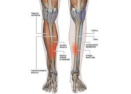 Obat tulang kaki ngilu herbal ace maxs adalah suplemen atau minuman kesehatan herbal yang terbuat dari ekstrak kulit manggis dan daun sirsak. Sakit Pada Tulang Kering Mungkin Physiogo Wangsa Maju Facebook