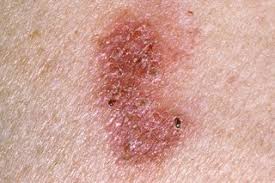 This symptom may occur as a result of complications of the disease, and itchy, flaky skin and rashes are common side effects of some cancer drugs. Bowen S Disease Nhs