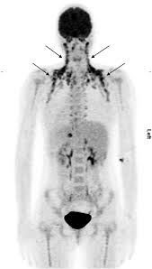 Maybe you would like to learn more about one of these? Brown Adipose Tissue And Thermogenesis