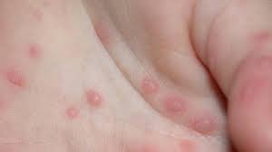 Check spelling or type a new query. Riscurile Unei AfecÅ£iuni Despre Care PuÅ£ini Au Auzit Boala ManÄ GurÄ Picior Este Extrem De ContagioasÄ