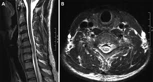 Image result for Neurosyphilis