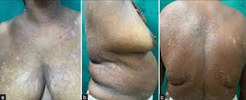 Image result for Erythrasma