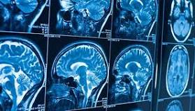 Image result for icd 10 code for malignant neoplasm of brain