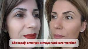 goz kapagi ameliyatimdan goruntuler iyilesme sureci dr akin banaz youtube