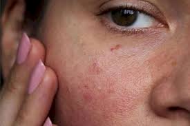 10 natural ways to get rid of red spots on face. Do Not Be Disturbed By Red Spots On The Face Just Follow These Home Remedies And See Amazing Suspense Crime Crime News Crime Suspense News Crime
