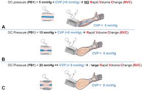 The cvp must clearly be influenced by the volume of blood in the central venous compartment and the conclusion. A Novel Non Invasive Device For The Assessment Of Cvp Mder