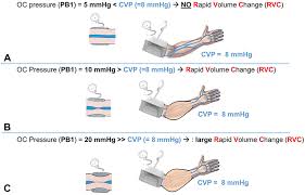 The ndings of this study revealed. A Novel Non Invasive Device For The Assessment Of Cvp Mder