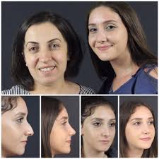 Izmit Burun Estetigi Bursa Rinoplasti Estetik