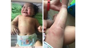 Feb 01, 2012 · onset of signs attributable to neonatal withdrawal from heroin often begins within 24 hours of birth, whereas withdrawal from methadone usually commences around 24 to 72 hours of age. My Baby Girl Went Through Topical Steroid Withdrawal