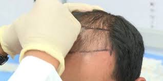 زراعة الشعر في السعودية Cooking Recipes Cooking Recipes
