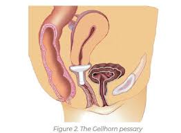 Image result for Pessary