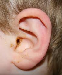 Swimmer's ear (also known as otitis externa) is a bacterial infection typically caused by water that stayed in the outer ear canal for a long period of time, providing a moist environment for bacteria to grow. Ear Infection Middle Ear Causes Symptoms Diagnosis And Treatment Natural Health News