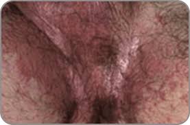 Que Es La Tina Inguinal Y Cuales Son Sus Causas Lotrimin