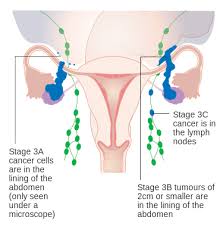 Complete resection of all visible. Ovarian Cancer Stages And Survival Rate Online Medical Library