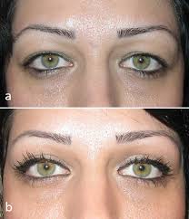 Full article: Upper blepharoplasty: advanced techniques and adjunctive  procedures