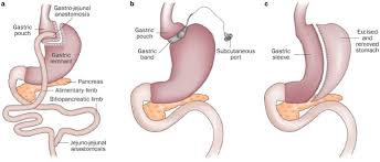 Mechanisms Underlying Weight Loss After Bariatric Surgery Nature Reviews Gastroenterology Hepatology Pinhole glasses icon, cartoon style. weight loss after bariatric surgery