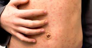 Sarampión: Alerta Epidemiológica y Aumento de Casos en Argentina