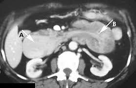 Image result for Succussion Splash